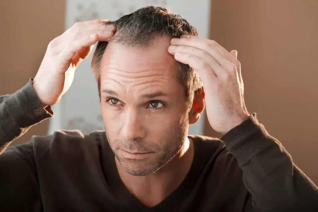 Duennes-und-lichtes-Haar-bei-einem-Mann