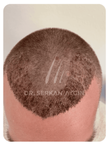 1 Week after hair transplant