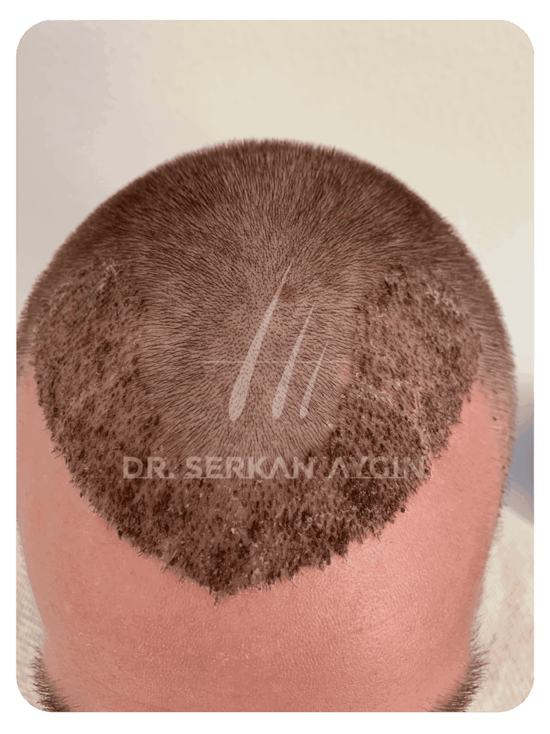 10 days after hair transplant