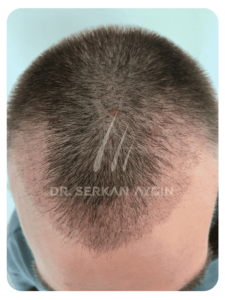 4 Weeks after hair transplant