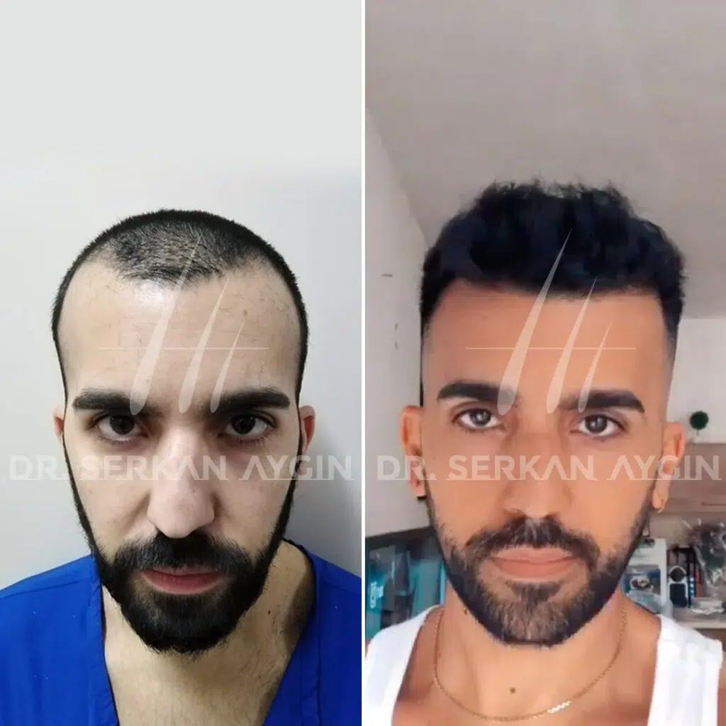 Geheimratsecken Haartransplantation vorher nachher ergebnis