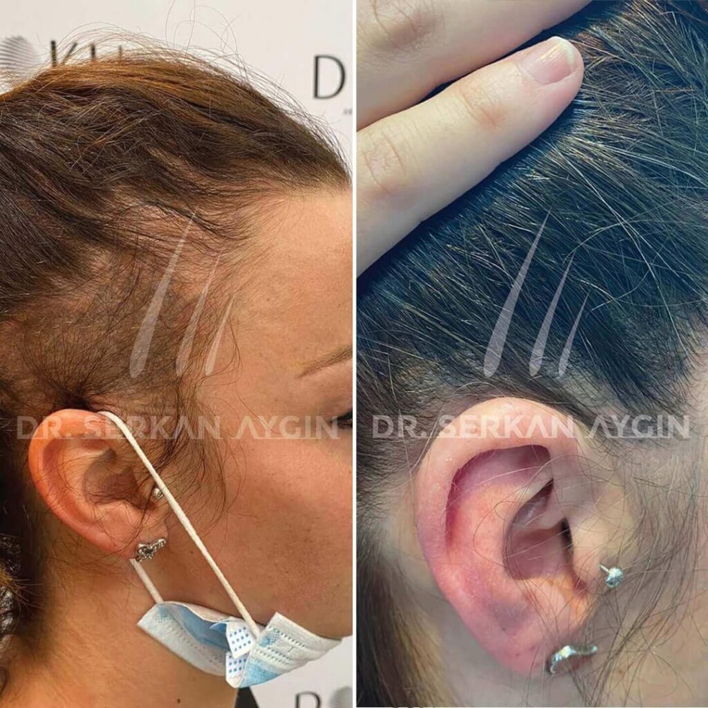Haartransplantation bei Frauen vorher nachher