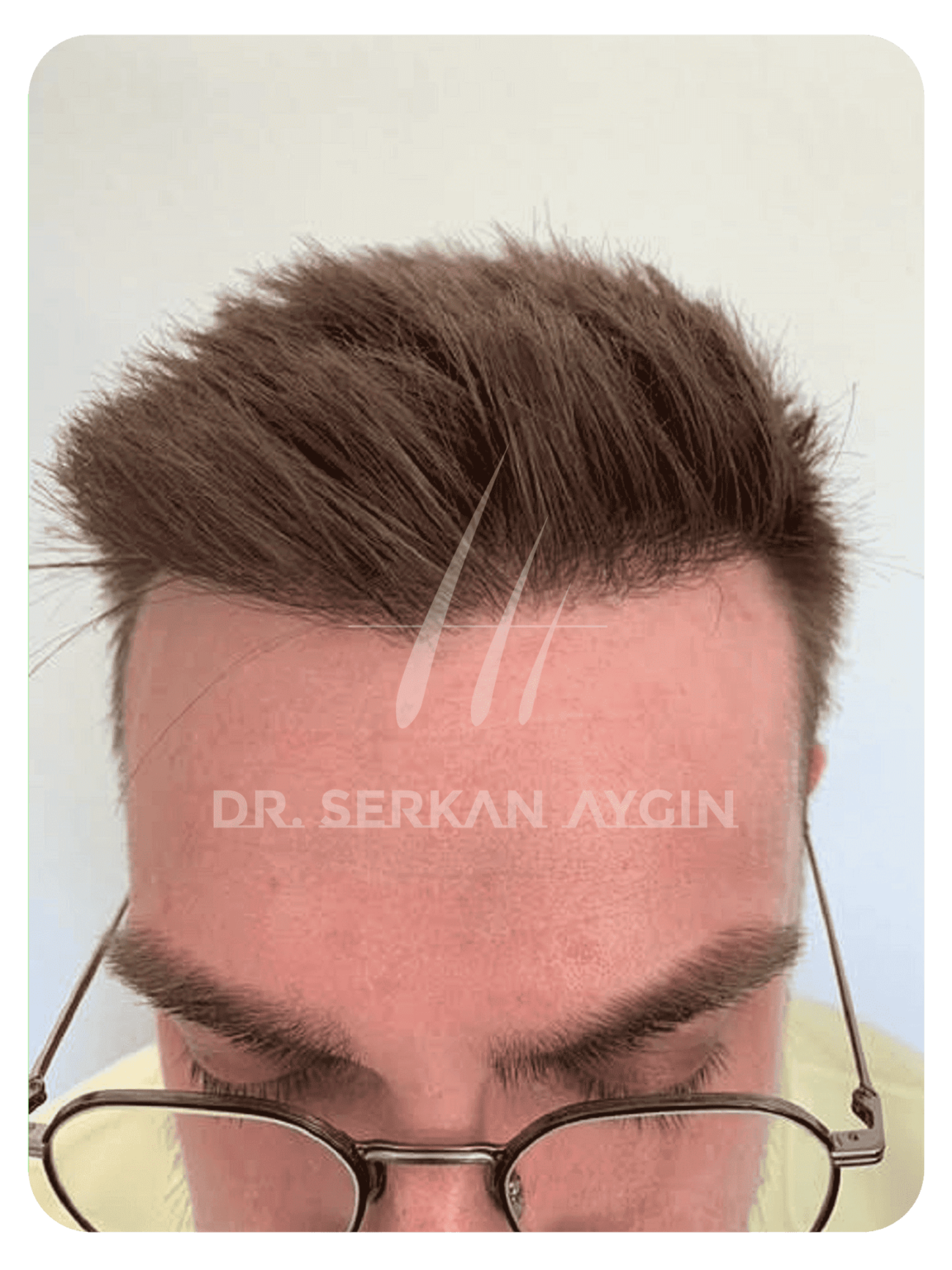 Hair Transplant Growth Chart A Timeline Dr Serkan Aygin Clinic