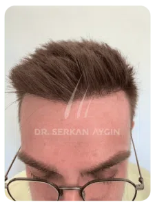 Hair transplant after 12 months