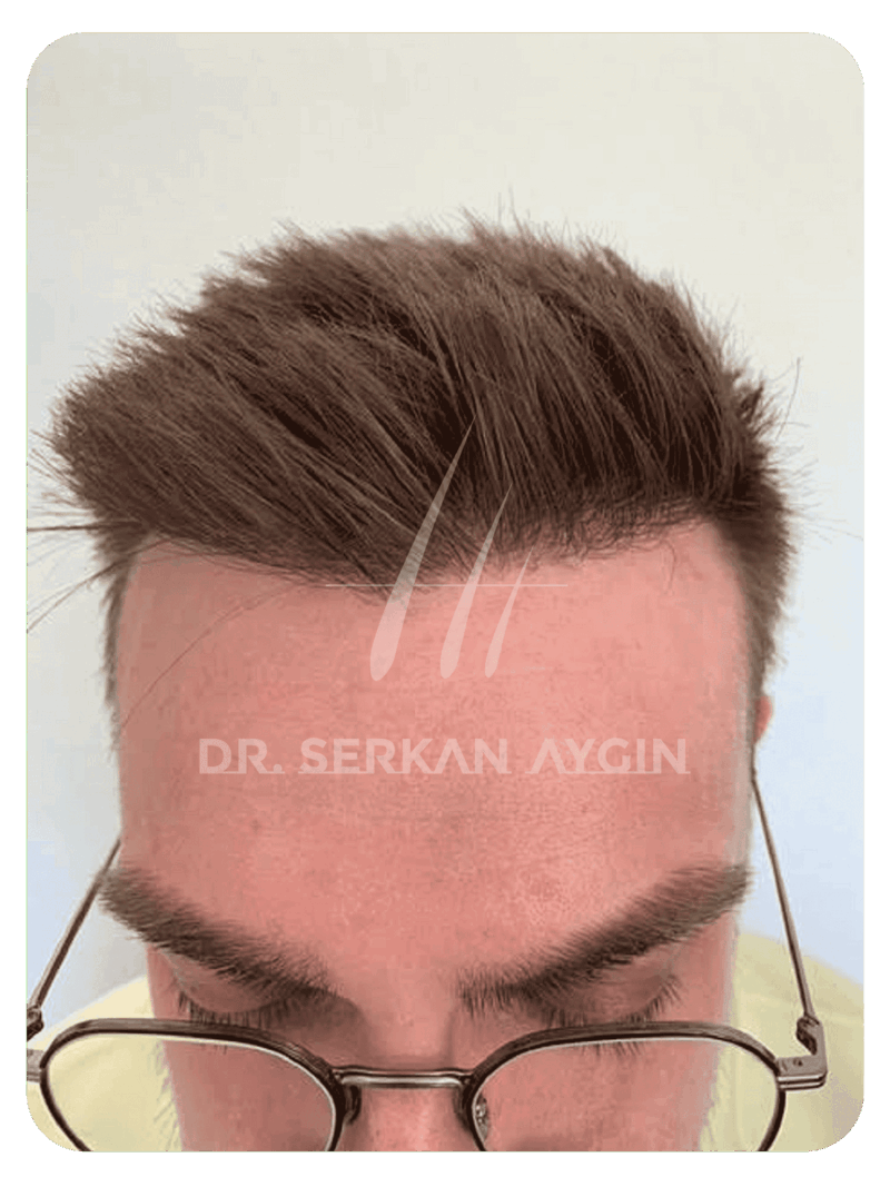 Hair transplant after 12 months