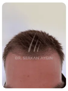 Hair transplant after 3 months