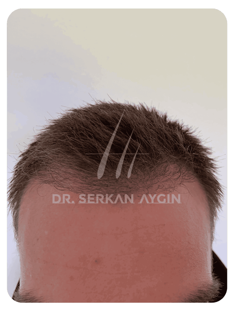 Hair transplant after 2 months