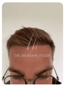 Hair transplant after 6 months