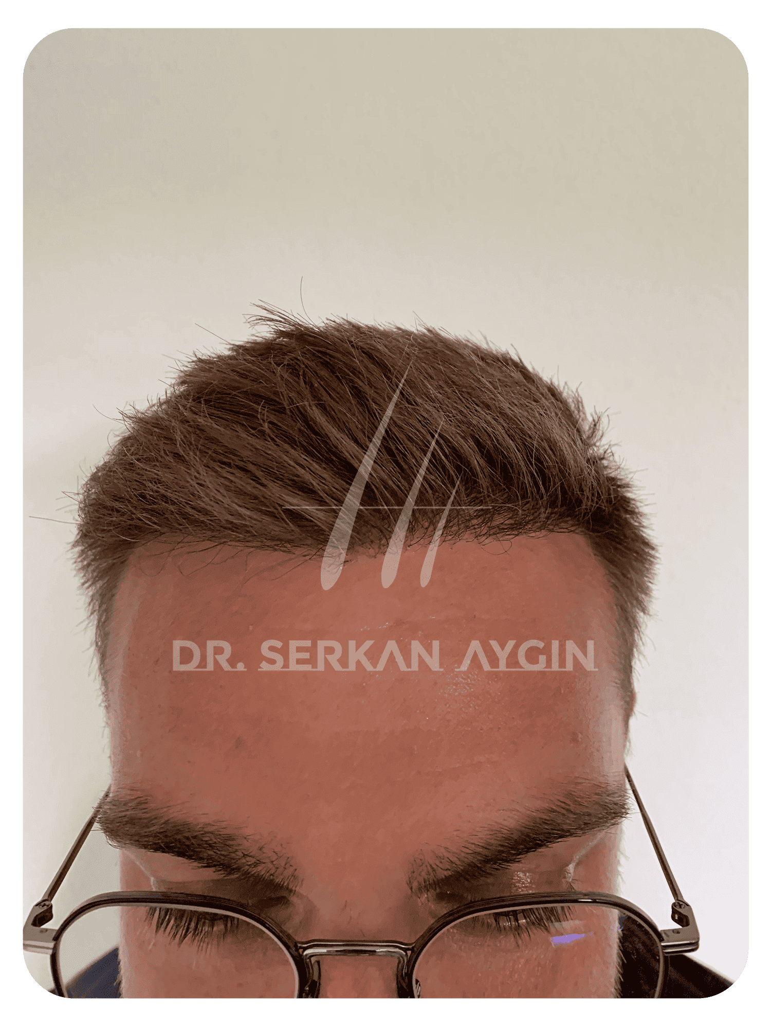 Hair Transplant Growth Chart A Timeline Dr Serkan Aygin Clinic