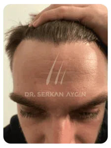 Hair transplant after 8 months