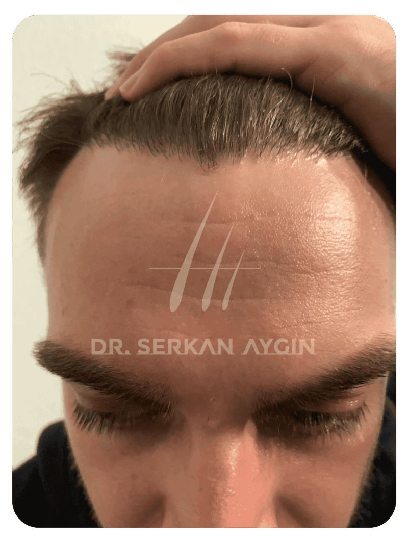 Hair transplant after 6 months