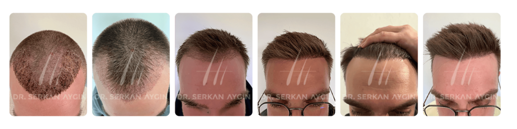 Hair transplant growth chart before after