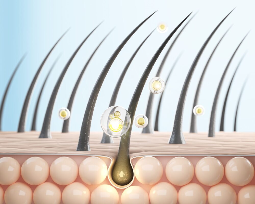 Cartoon-like illustration of a scalp mid-section showing how dermatitis can cause hair loss
