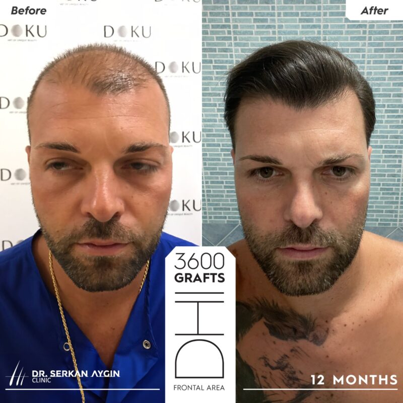 double picture of a patient displaying the results of a stem cell hair transplant before an after