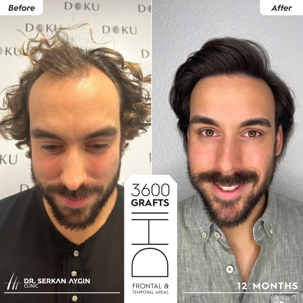 Double picture of a long-haired patient showing a second case result of a stem cell hair transplant before and after