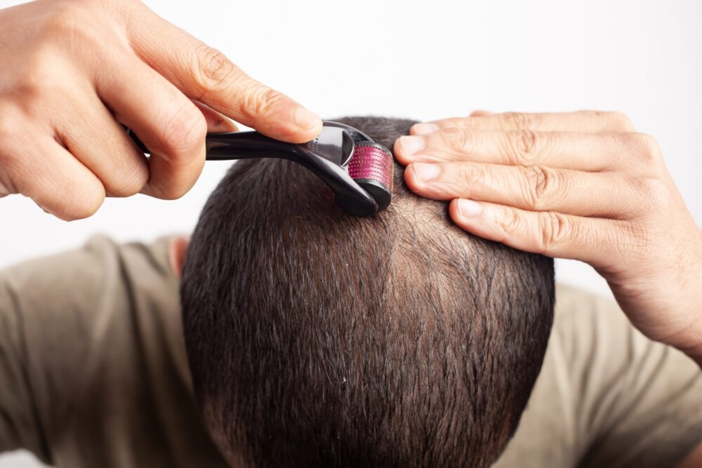 Nahaufnahme eines Patienten, der zeigt, wie man einen Dermaroller für die Haare verwendet.