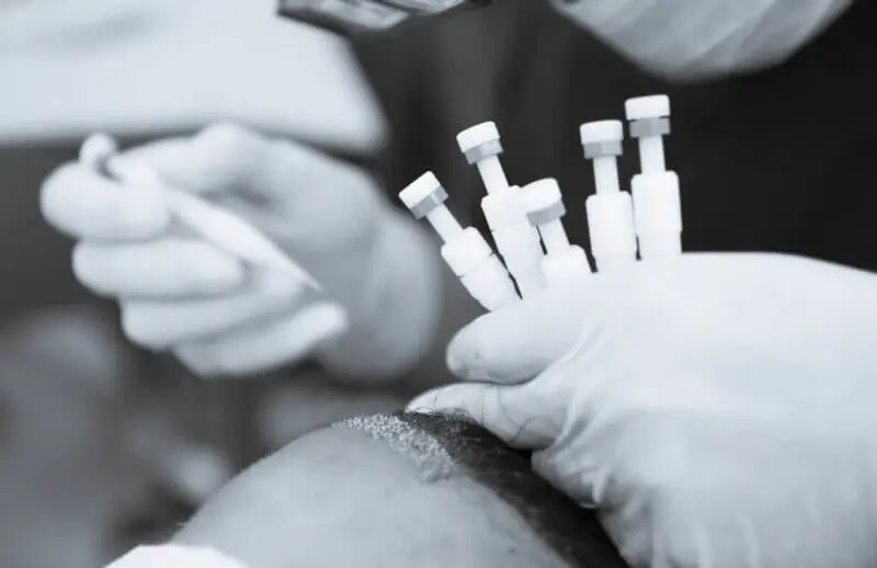 Cost of DHI hair transplant method in Turkey with pricing overview