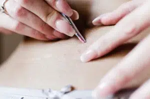 Illustration of plucking as an ingrown hair treatment