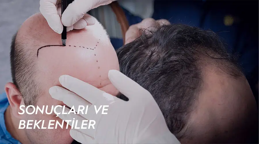 40 yaş üstü saç ekimi sonuçları ve hasta beklentileri