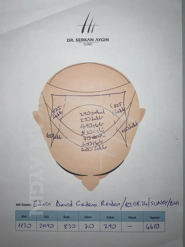 Hair transplant preparation sheet - procedure planning at the Dr. Serkan Aygin Clinic