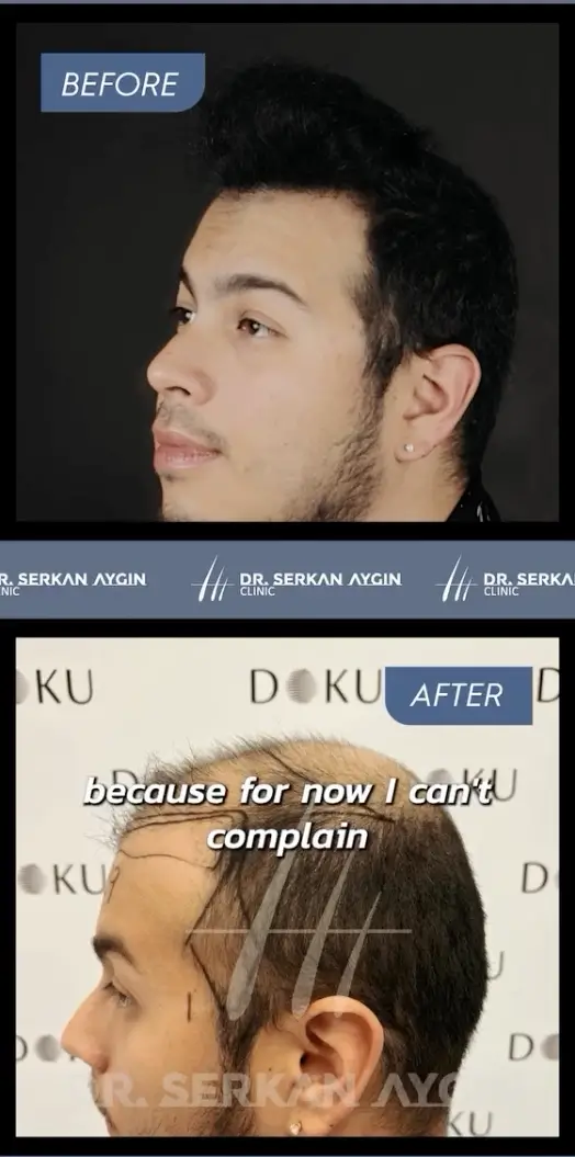 Hair transplant before and after in Turkey