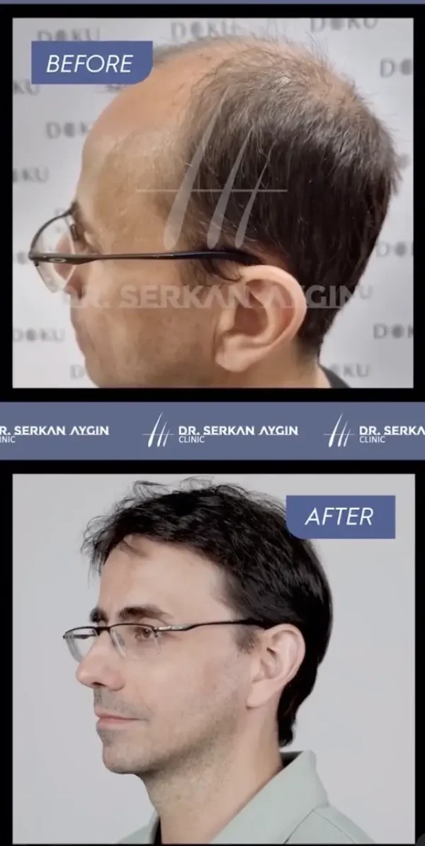 William's hair transplant before and after in Turkey