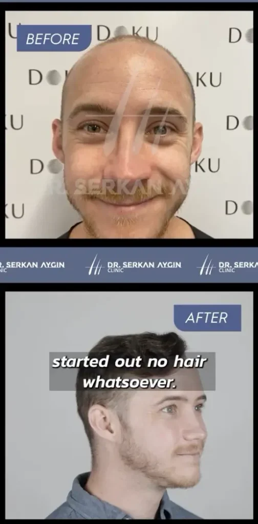 Jonathan’s Second Hair Transplant Before & After