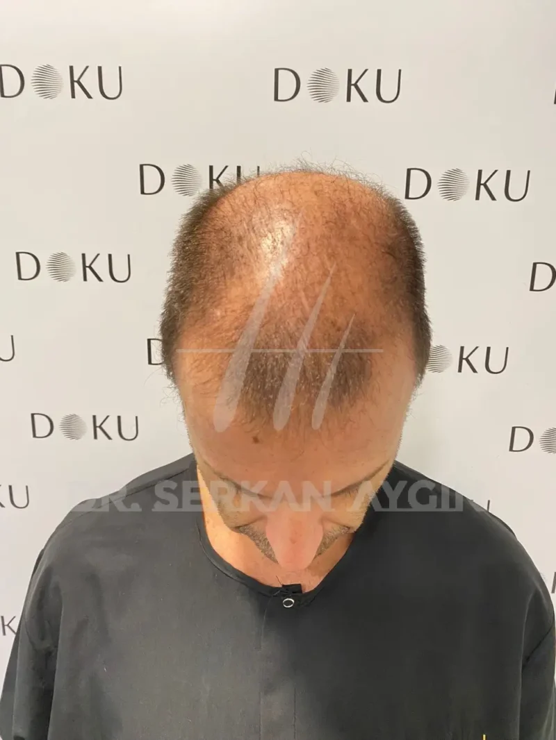 Hair transplant before picture of Jorge