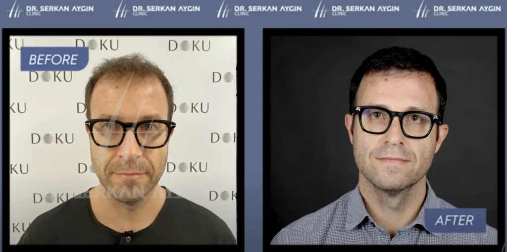 Jorge’s Hair Transplant Experience in Turkey: Before and After at Dr. Serkan Aygin Clinic