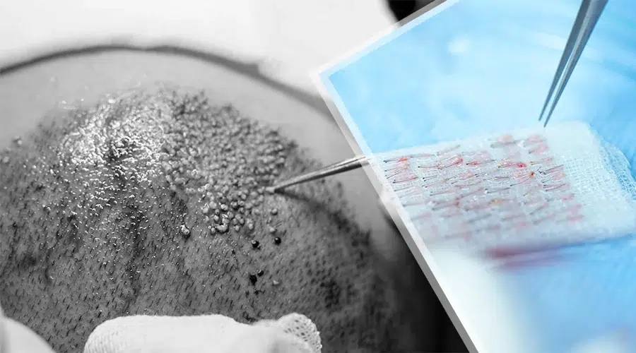 Saç folikülünün anatomik yapısı ve önemi