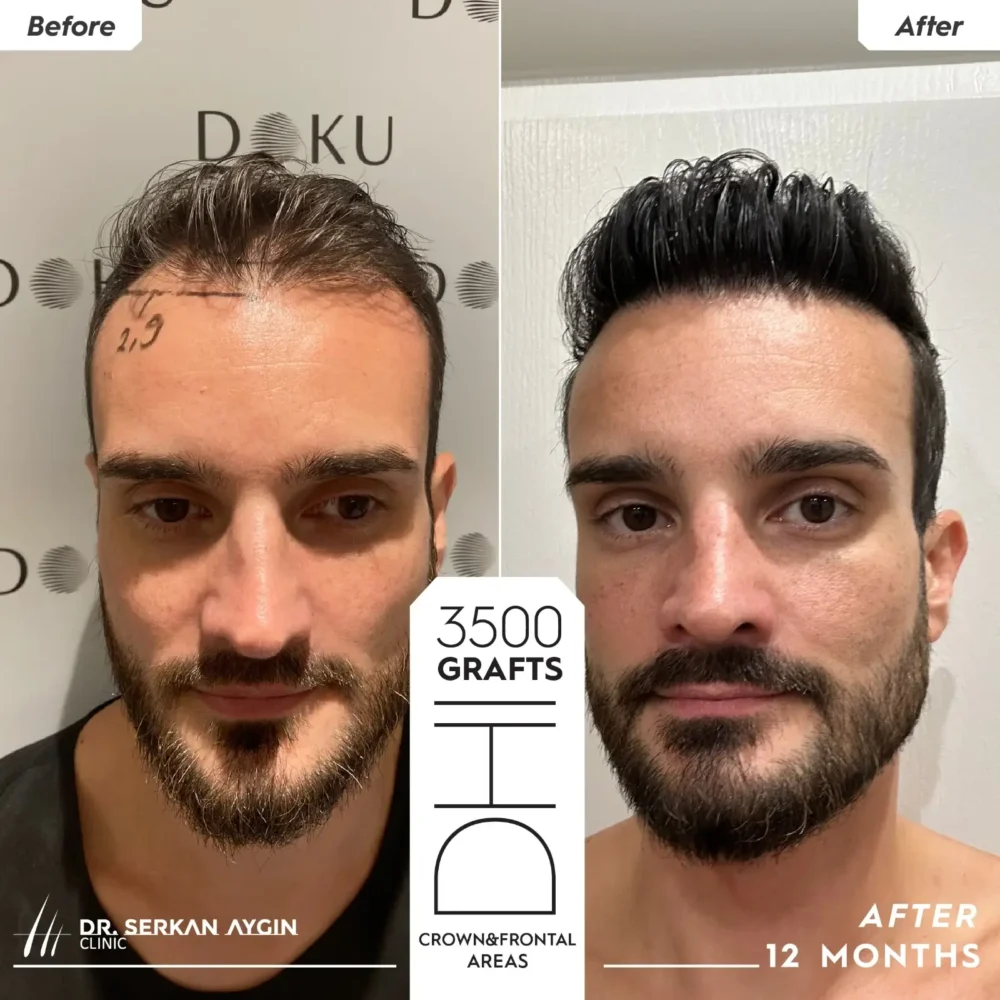 Two symmetrical pictures of patient Bastian for his hair transplant before after in Turkey results