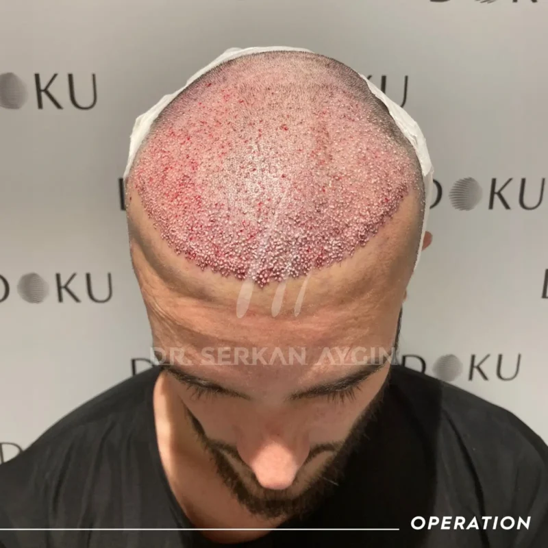 Bastian nach seiner Haartransplantation Türkei