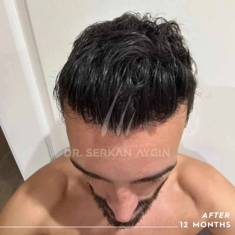 Risultati di Bastian 1 anno dopo il suo trapianto di capelli Turchia