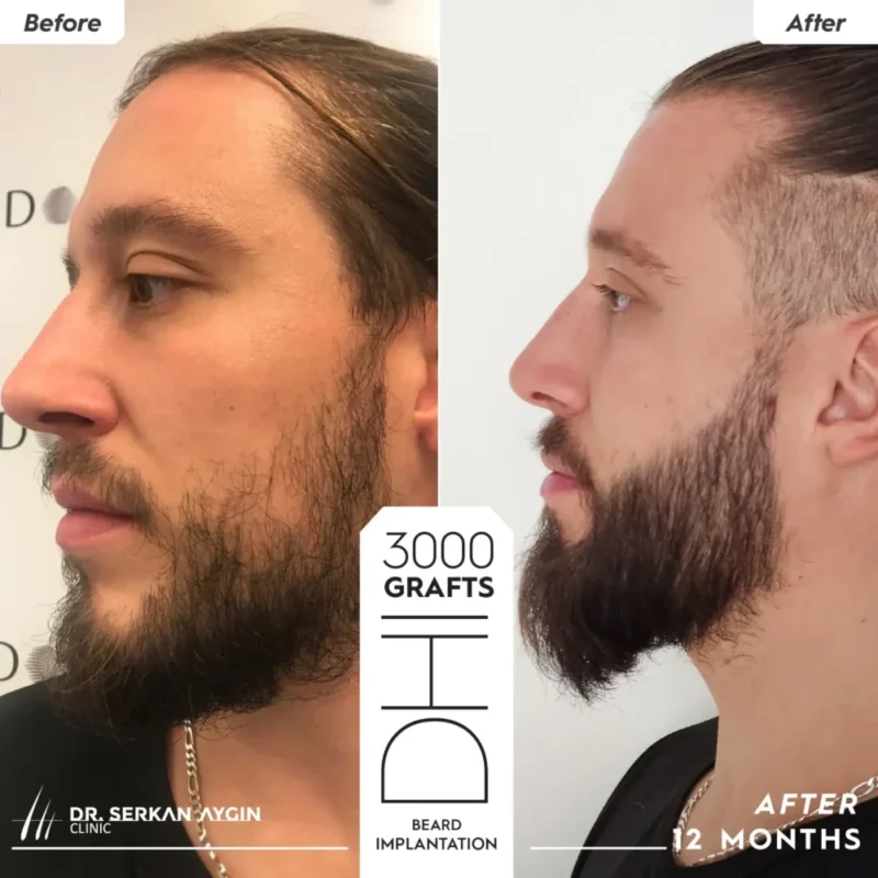 Greffe de barbe en Turquie avant après de Frédéric pour 3,000 greffons