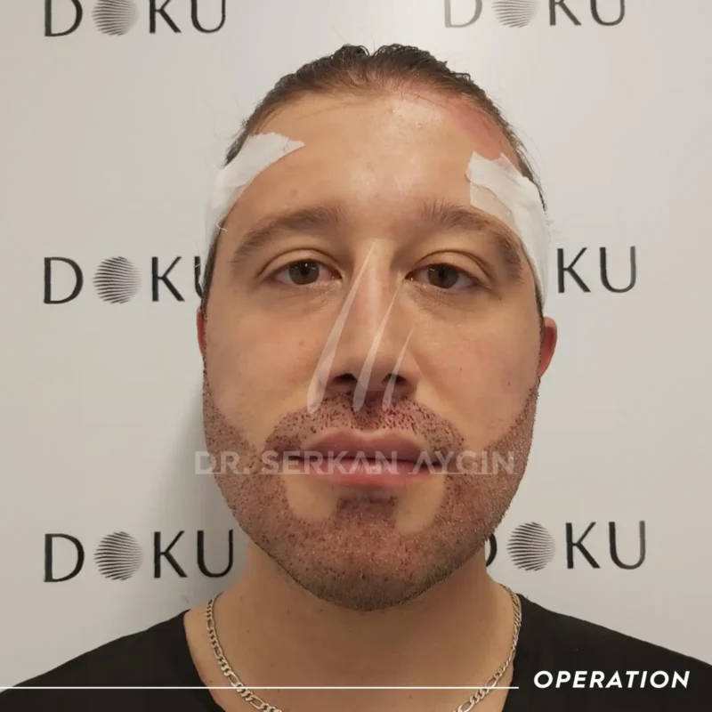 Frédéric après sa greffe de barbe Turquie à la clinique du Dr. Serkan Aygin