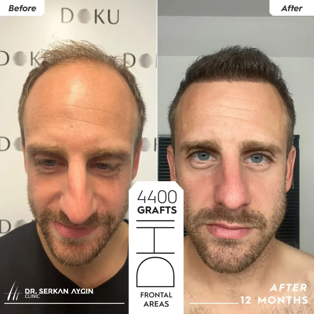 Fritz hair transplant before and after pictures