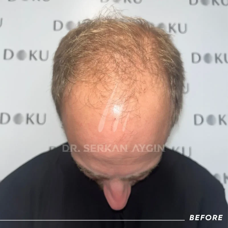 Fritz before his hair transplant in Turkey