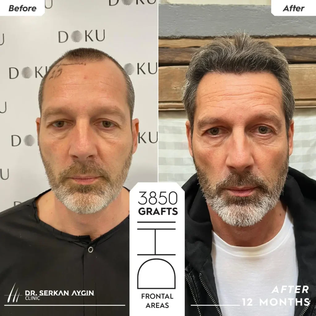 Klötz’s 4000 Grafts Hair Transplant Before & After