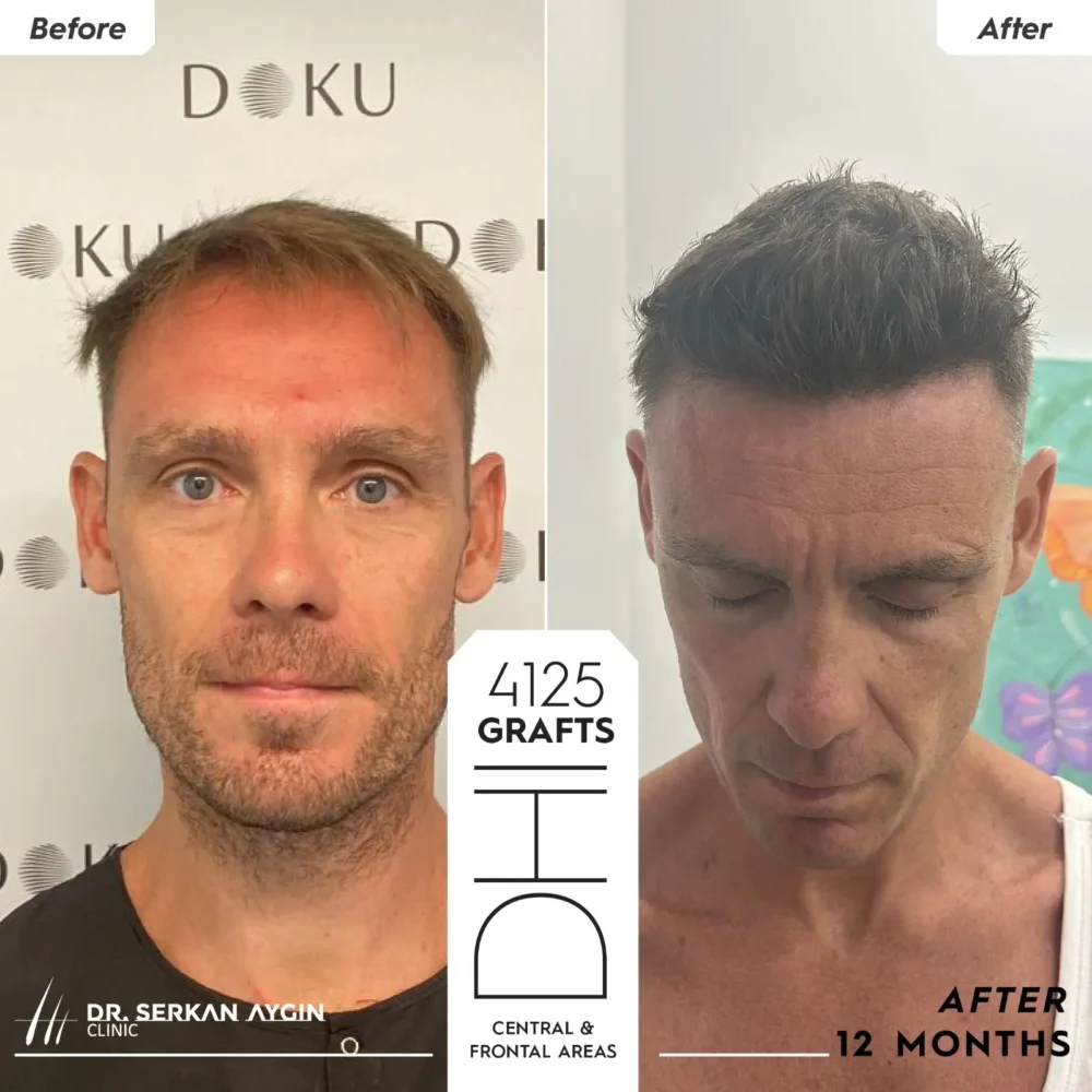 Patient Magnus' hair transplant Turkey before and after pictures at the Dr. Serkan Aygin Clinic