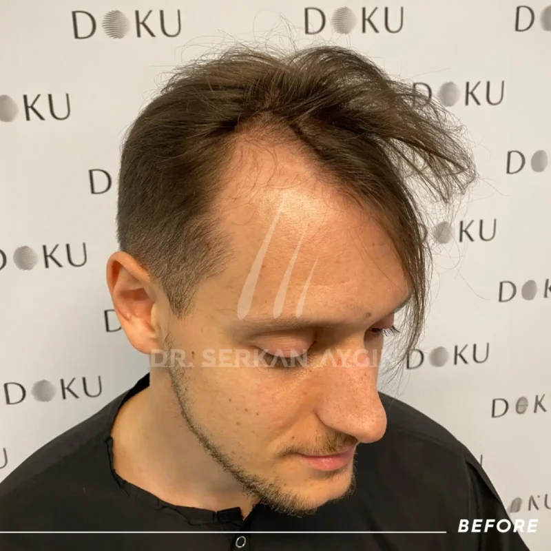 Rory before his hair transplant Turkey