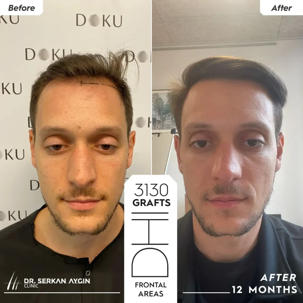 Rory's hair transplant before and after photos after his 1-year wait following his procedure at the Dr. Serkan Aygin Clinic in Turkey