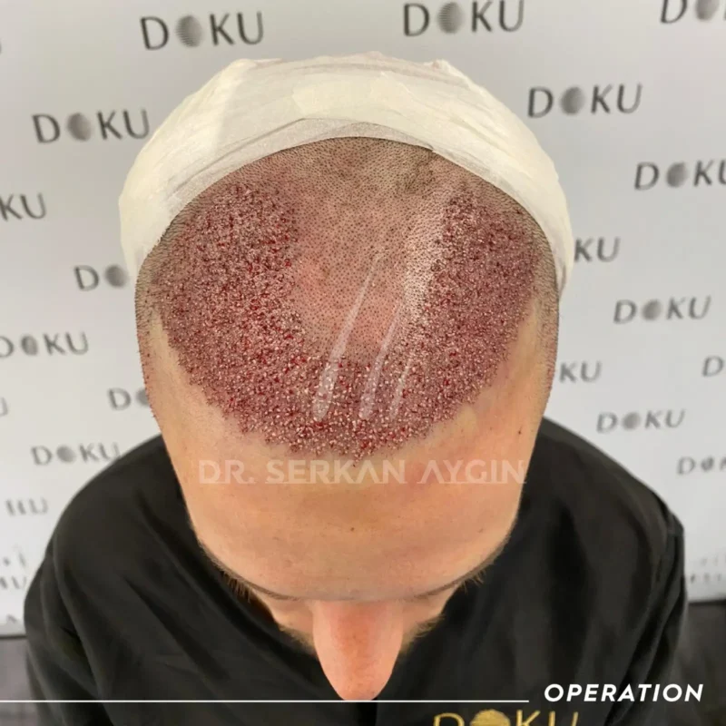 Rory nach einer Haartransplantation Türkei