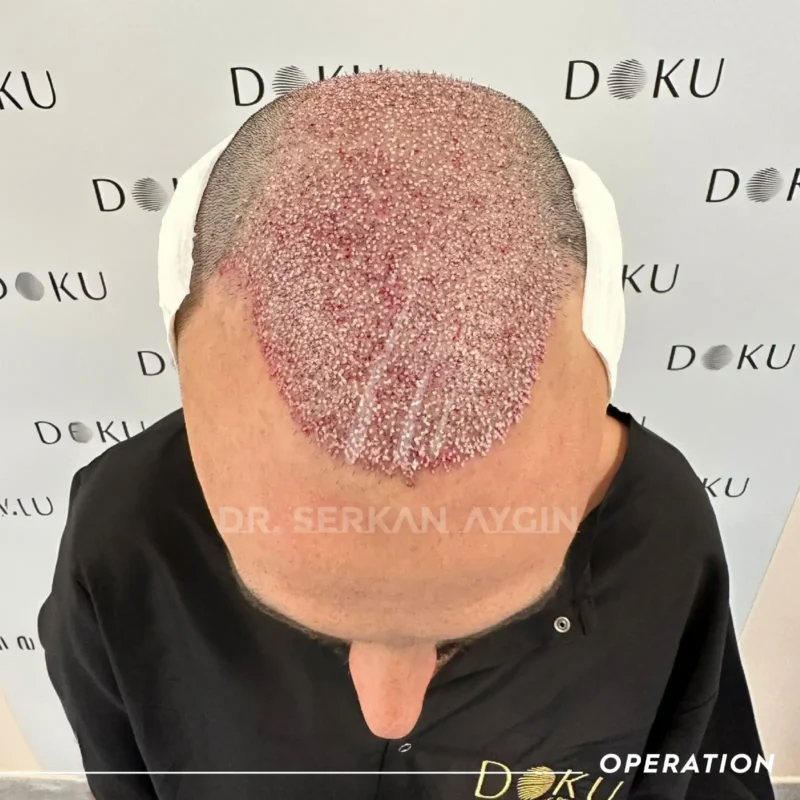 Sébastian après la greffe de cheveux turquie