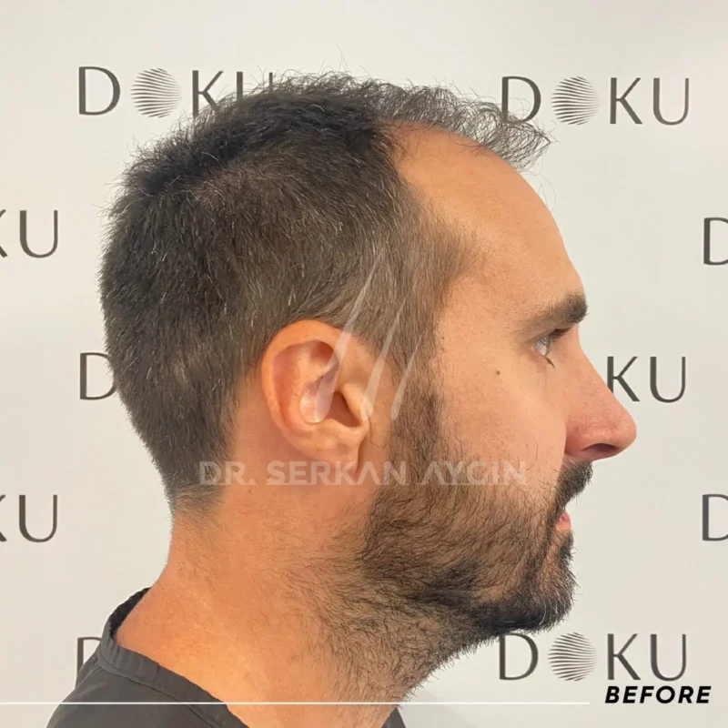 Sébastian prima del suo trapianto capelli turchia