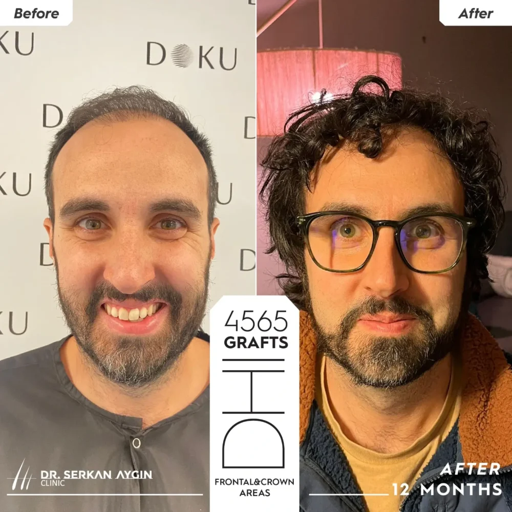 Sébastian's Turkey hair transplant before and after results
