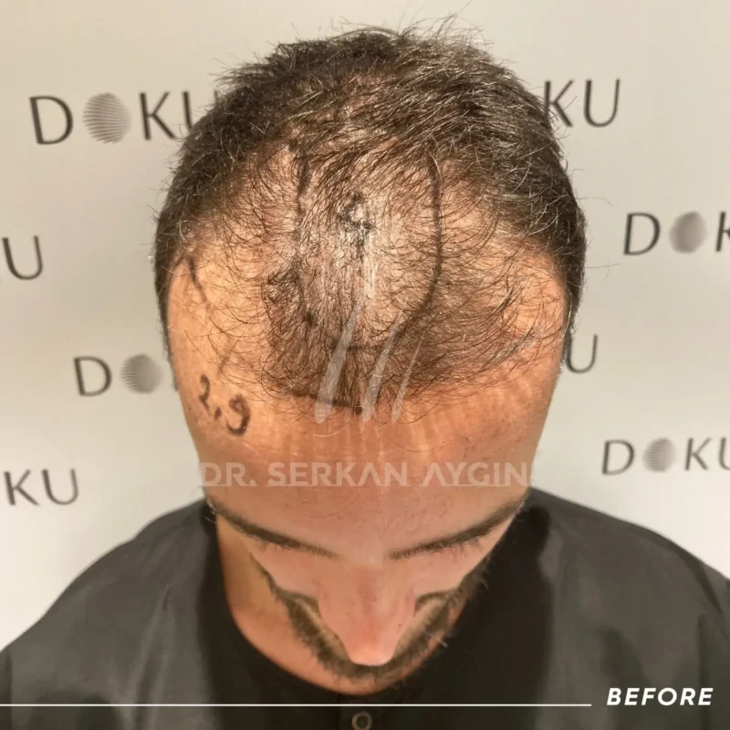Patient Bastian with Norwood 5 hair loss before his Turkey hair transplant