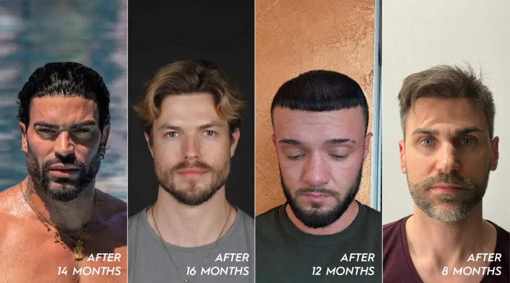 Influencers before and after hair transplant