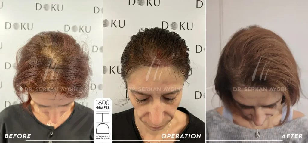 hair transplant before and after