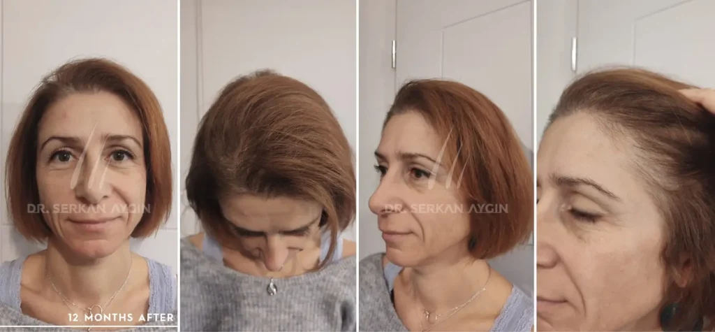 women hair transplant