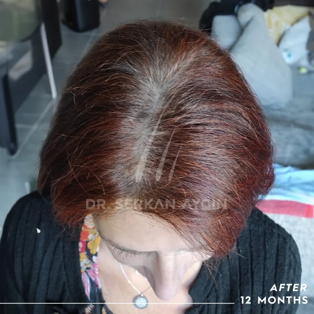 women hair transplant